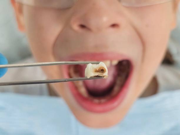 Best Emergency Treatment for Dental Infections or Abscesses in Phillipsburg, KS